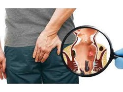 PILES SPECIALIST DOCTOR 27789982777